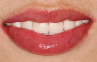 上海溶脂針瘦肩醫(yī)生