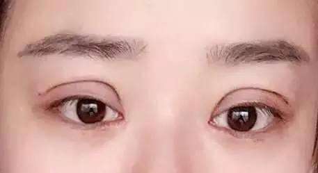 寧波提拉眼睛細(xì)紋醫(yī)生