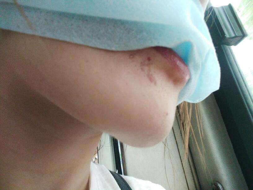 成都線雕祛除法令紋醫(yī)生