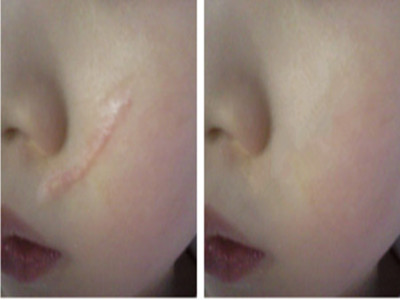 宜賓小分子玻尿酸填充醫(yī)生