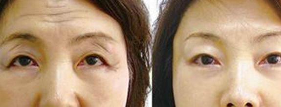 湖州肉毒素除眼部細紋醫(yī)生