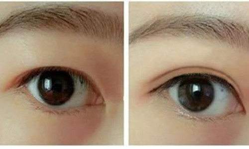 寧波拉皮去除眼睛細紋醫(yī)生