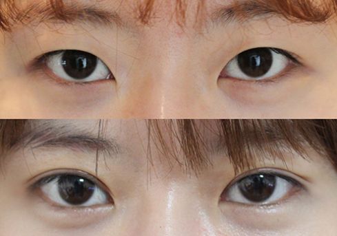 廣安微針祛除眼角紋醫(yī)生