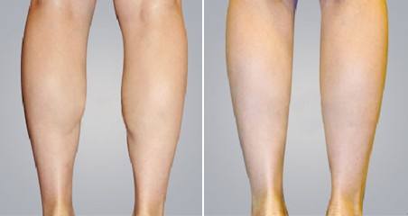 南京面部溶脂術(shù)醫(yī)生