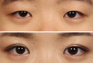 南京微創(chuàng)眼睛細紋手術醫(yī)生