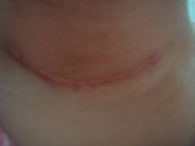 南京精雕雙眼皮醫(yī)生