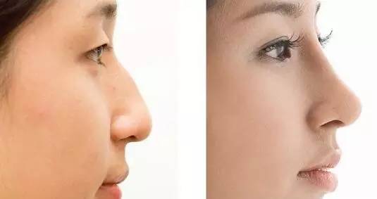 深圳瘦大腿吸脂術(shù)醫(yī)生