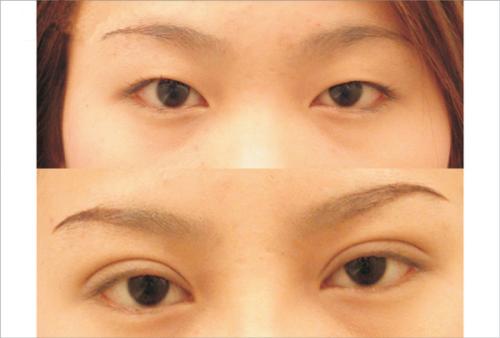 烏魯木齊內(nèi)窺鏡除皺去細(xì)紋醫(yī)生