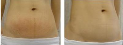 浙江專業(yè)無(wú)痕除皺術(shù)醫(yī)生