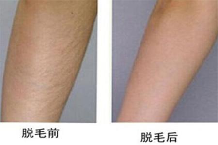 廣州激光治療酒渣鼻醫(yī)生