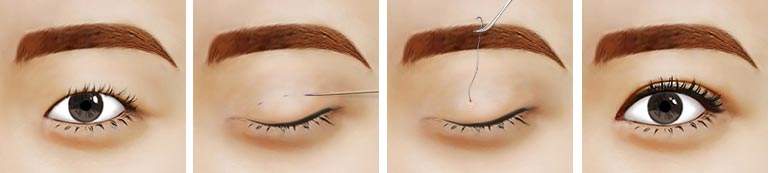 2023年天津公立醫(yī)院雙眼皮手術(shù)排名及網(wǎng)友好評(píng)！