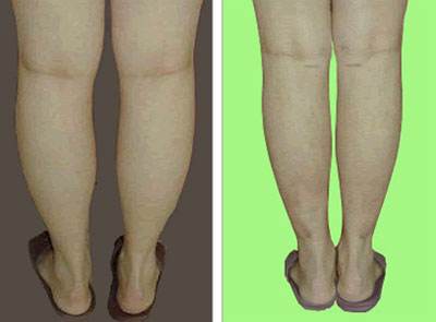 杭州打針去細紋醫(yī)生