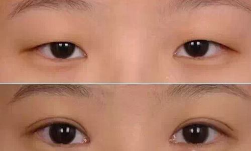 阜新點陣祛川字紋醫(yī)生