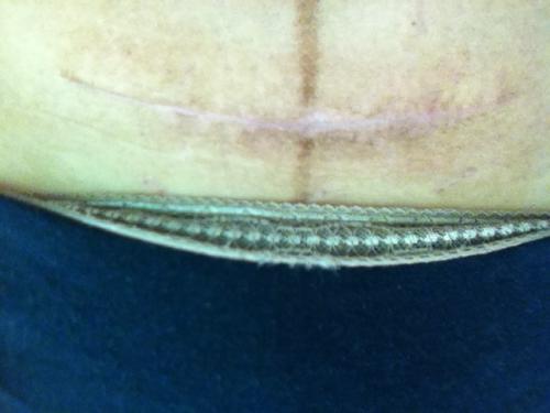 杭州注射物隆鼻醫(yī)生