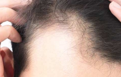 【溫州整形醫(yī)院】哪種埋線雙眼皮更適合？芘麗芙與伯思立對比及過來人經(jīng)驗分享