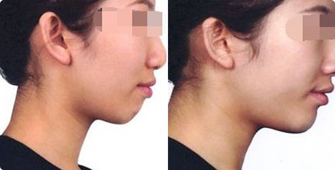 常州雙眼皮整形醫(yī)院精選六家頂級(jí)醫(yī)院，詳情提前公布！