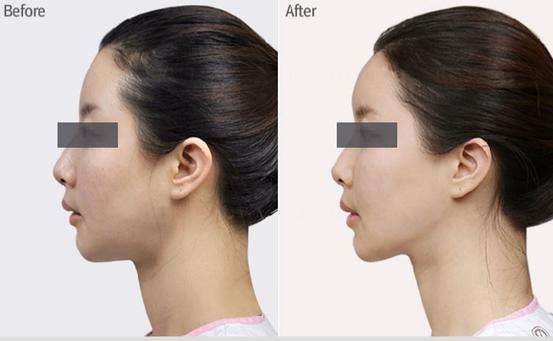 寧波哪家醫(yī)院的拉皮手術(shù)技術(shù)獨步全市？精選的前五醫(yī)院名單，藝星、薇琳等都上榜！