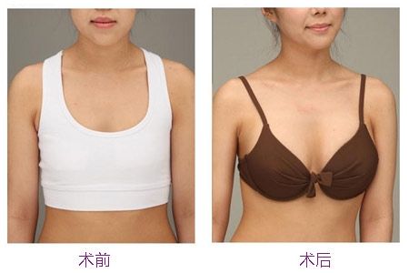 鎮(zhèn)江膠原蛋白去除抬頭紋醫(yī)生