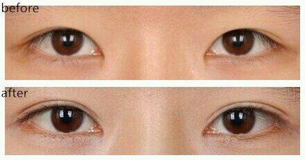 蘭州假體隆胸手術醫(yī)生