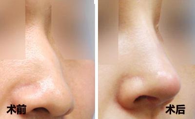 鎮(zhèn)江精細(xì)祛眼袋醫(yī)生