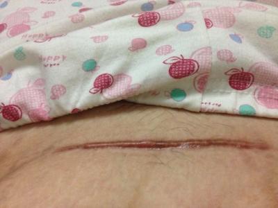 中山抽脂減肥醫(yī)生