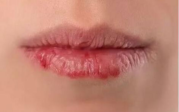 長沙寬鼻梁矯正醫(yī)生