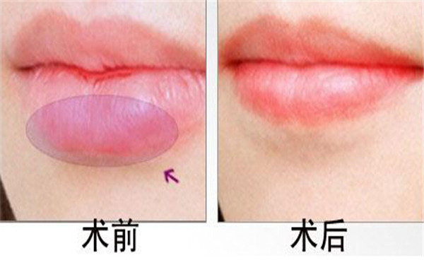 常德平滑吸脂瘦身醫(yī)生