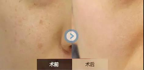 海寧下頜角磨骨整容 醫(yī)生