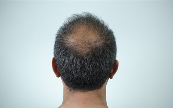 杭州哪家醫(yī)院做脈沖強光去痘效果好呢？