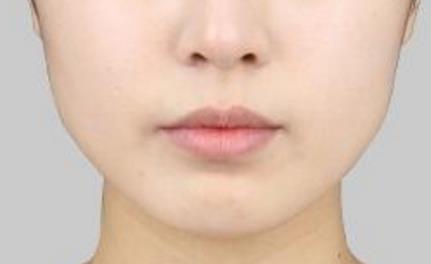 桂林光波祛眼袋醫(yī)生