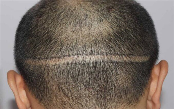 2023年天津黑眼圈治療醫(yī)院推薦，看看那位醫(yī)生的技術厲害