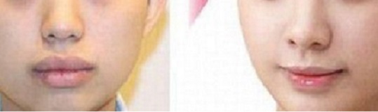 2023長(zhǎng)沙微針去痘哪家醫(yī)院技術(shù)出眾？長(zhǎng)沙微針去痘排名前十專業(yè)醫(yī)院揭秘！