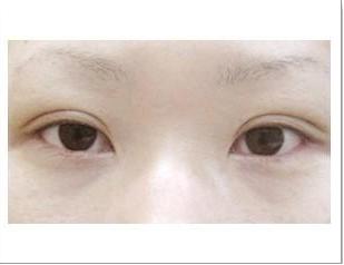 廣州有效祛斑的指導(dǎo)：2023年比較推崇的激光去斑醫(yī)院前十強