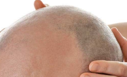 2023年十大口碑好的深圳水光針去眼底紋整形醫(yī)院揭秘！