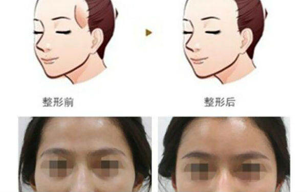 洛陽哪家醫(yī)院做木偶紋效果好？2023榜單出爐，洛陽物理去木偶紋top10佳選露面！