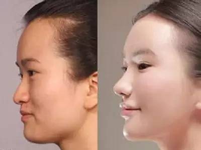 2023年，哪些上海自體脂肪面部精雕整形醫(yī)院的口碑特別好？排名榜前十值得信賴的美容整形醫(yī)院！