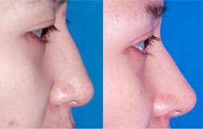 寧波2023年非常受歡迎的立體吸脂術醫(yī)院前10強震撼發(fā)布！