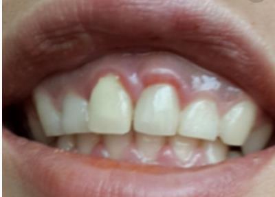 黃石哪家醫(yī)院能填充太陽穴假體？2023黃石太陽穴美容前十有哪些好選擇！