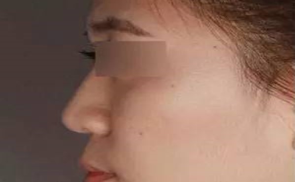 2023年?？谏漕l微針去眼角細(xì)紋哪個(gè)醫(yī)院比較好？?？谘劢羌?xì)紋整形美容醫(yī)院排行榜綜合報(bào)道！