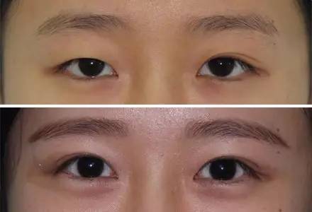 杭州駝峰鼻矯正哪家整形醫(yī)院技術(shù)獨(dú)特？2023杭州駝峰鼻矯正排名前10的醫(yī)院評(píng)測(cè)揭曉！