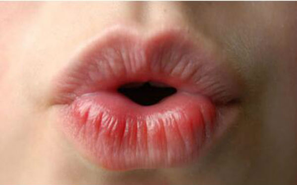 北京玻尿酸填充臉頰凹陷醫(yī)生