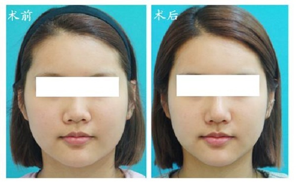 南陽哪家醫(yī)院注射鼻基底效果好？2023南陽玻尿酸注射鼻基底排行榜出爐！全城皆贊的十大醫(yī)院盤點(diǎn)！