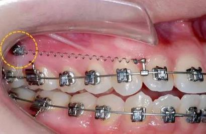 杭州哪家醫(yī)院做玻尿酸填充淚溝好？2023年排行榜公布！