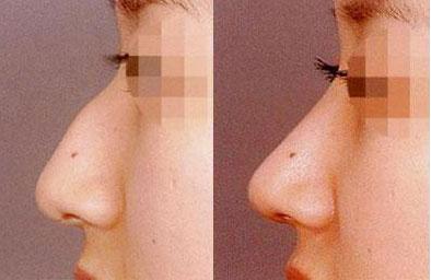 江陰溶脂針瘦背哪家整形美容醫(yī)院更受推薦？2023年江陰比較好的溶脂針瘦背醫(yī)院排行榜揭曉！前10強名單一覽！