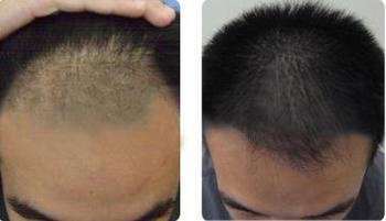 鎮(zhèn)江哪家醫(yī)院效果好？2023年玻尿酸填充額頭美容醫(yī)院排名全新預測！