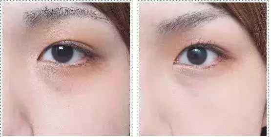 2023德州眼底紋玻尿酸注射整形美院排行榜，你知道嗎？