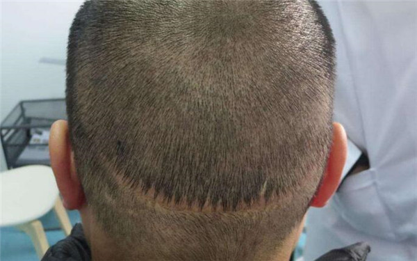 重慶十家熱門醫(yī)院推薦！2023重慶超聲去除黑眼圈美容醫(yī)院精選十強(qiáng)深度評(píng)判！