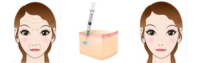 2023年溫州哪家整形醫(yī)院效果比較好？去生長(zhǎng)紋，熱拉提推薦！