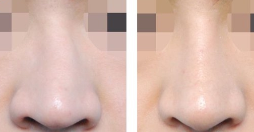 湖南哪家醫(yī)院比較好做光乳化手術(shù)祛眼袋？湖南2023年全國(guó)十佳整形醫(yī)院眼袋療效！推薦！