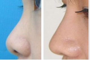 2023年海南哪家整形醫(yī)院口碑好？填充淚溝效果受網(wǎng)友推薦的醫(yī)院有哪些？